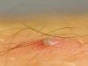 Вросшие волосы после эпиляции: причины, симптомы и методы удаления