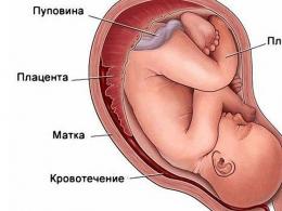 De ce apare un hematom în uter în timpul sarcinii?