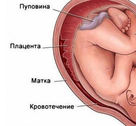 Perché si verifica un ematoma nell'utero durante la gravidanza?