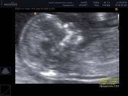 Doplerometrija fetusa: norme po sedmicama, dekodiranje indikatora
